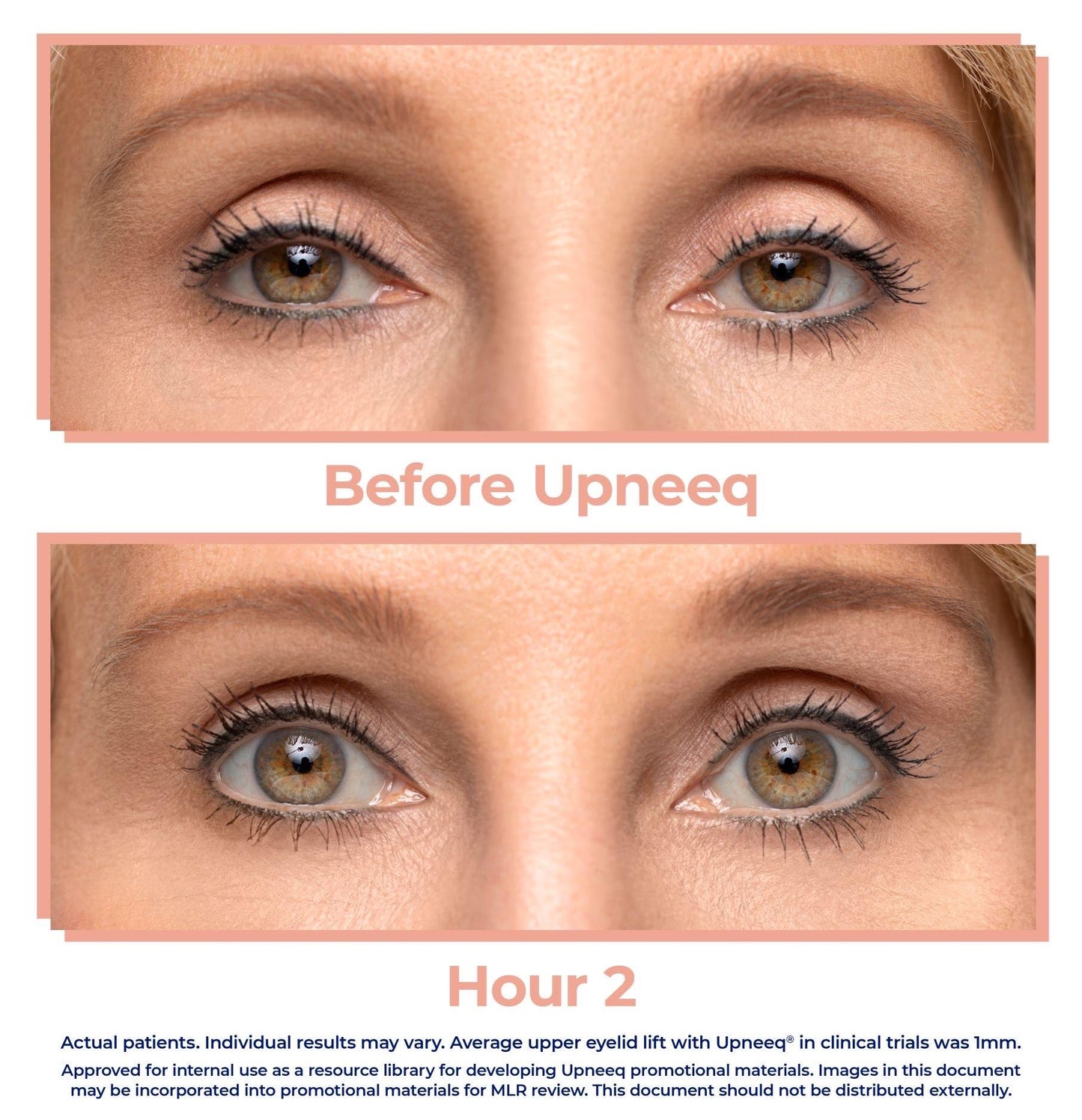 2 - PACK UPNEEQ EYE (Full Size Box) BUNDLE - ONASSIS SKIN